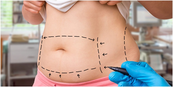 How different is Liposuction from lap band