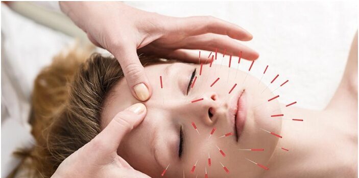 Facial acupuncture vs. Botox