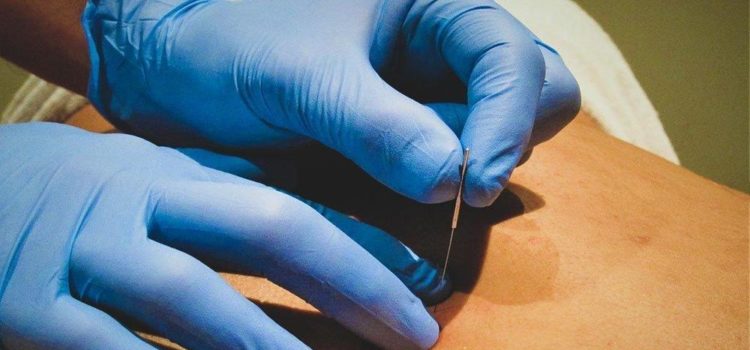 What To Know About Dry Needling Supplies
