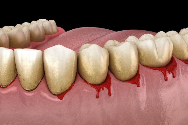 Bleeding Gums