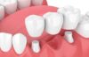 Dental Bridges