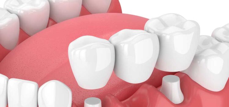 Dental Bridges