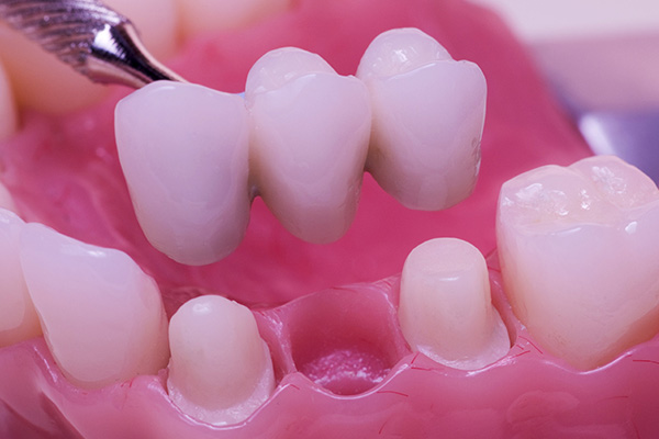 Dental Bridges